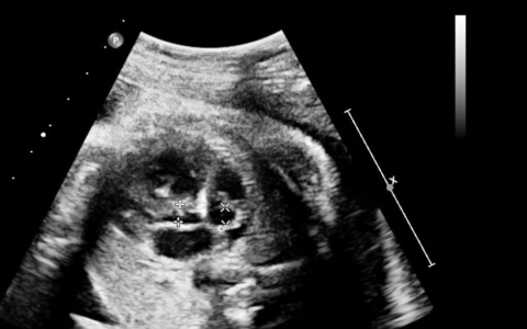 Ospedale Santa Rosa, attivo il nuovo ambulatorio di ecocardiografia fetale