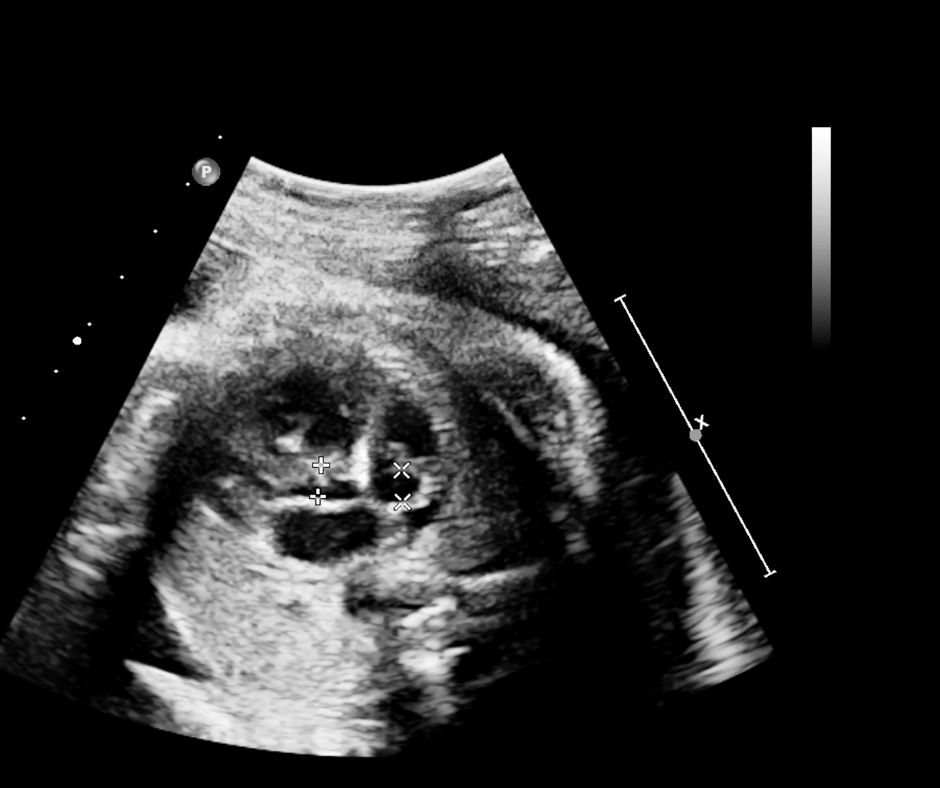 Ospedale Santa Rosa, attivo il nuovo ambulatorio di ecocardiografia fetale